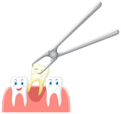 Extraction of Teeth