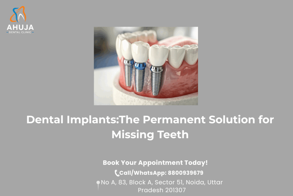Dental implants in noida