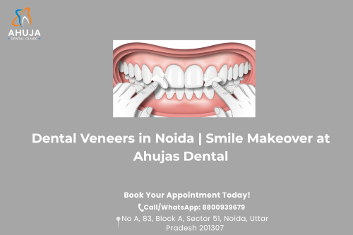 Dental Veneers